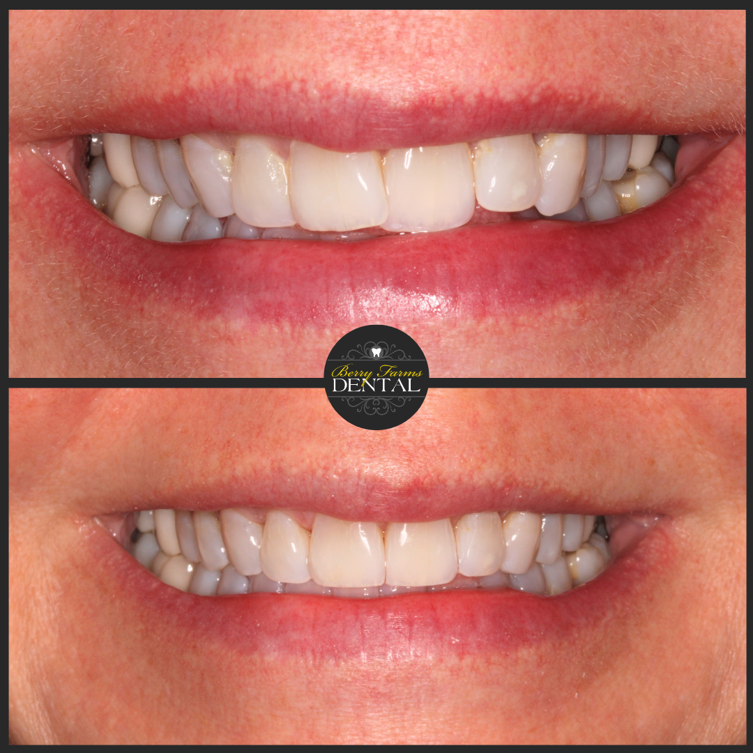 Invisalign - Kim Nowell