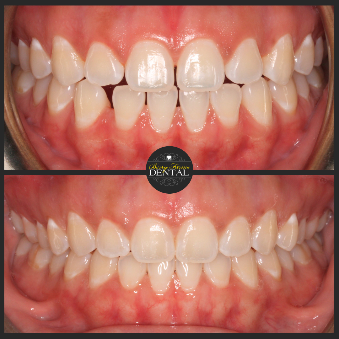 charlye Invisalign (2)
